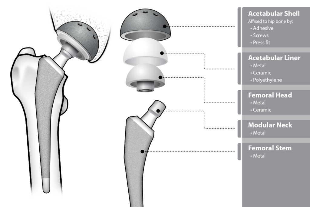 Hip Replacement Components